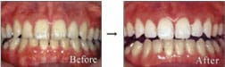 審美歯科の治療について