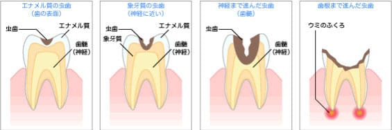 むし歯はこのように進行していきます。