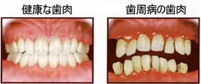 健康な歯肉  歯周病の歯肉