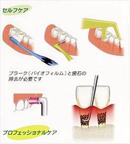 ブラッシングと歯石除去