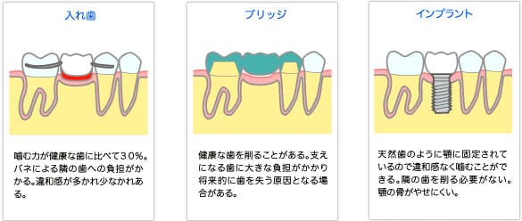インプラント 丹歯科医院 本来の噛む機能を取り戻すことができます