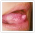 舌良性腫瘍