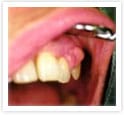 歯肉良性腫瘍