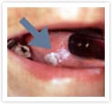 舌癌（扁平上皮癌）
